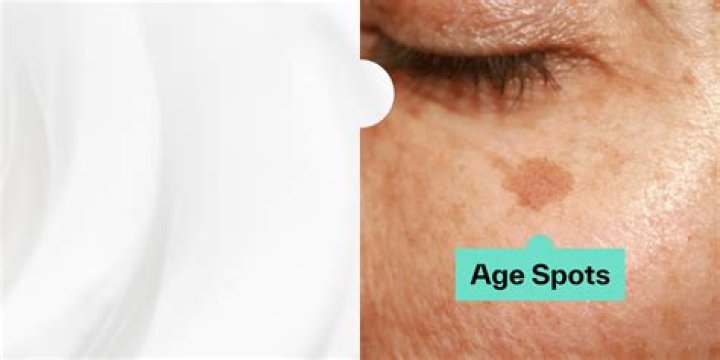 Does baking soda get rid of age spots?