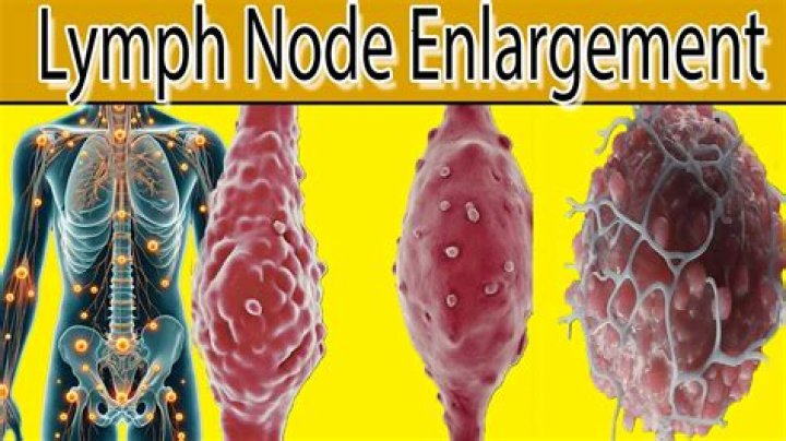 What size is considered an enlarged lymph node?